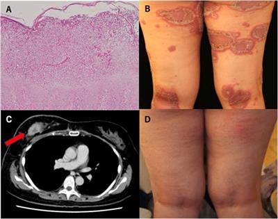 Generalized pustular psoriasis with breast cancer successfully treated with granulocyte and monocyte adsorptive aphaeresis and brodalumab